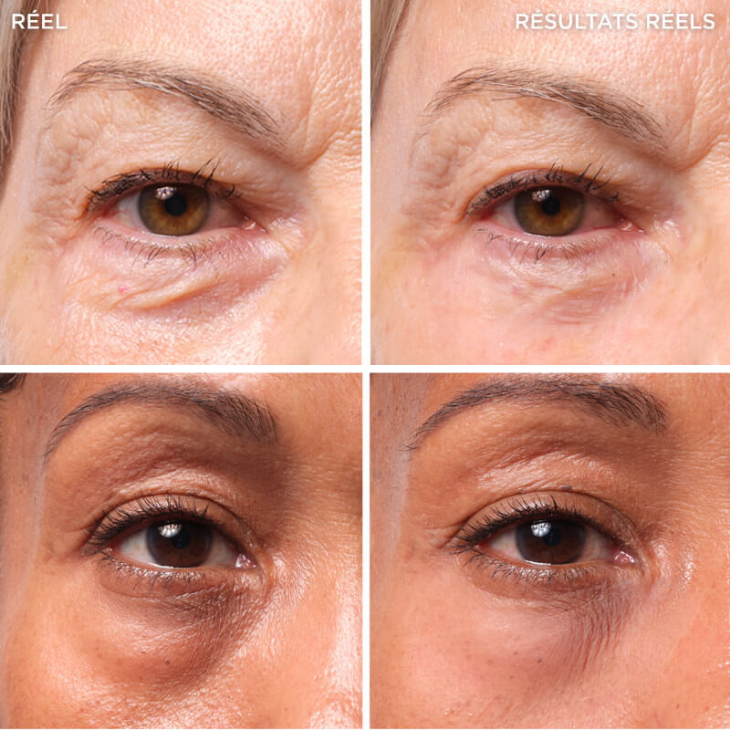 Bye Bye Under Eye Bags 2